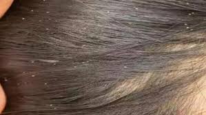 تفسير حلم نزع القمل من الشعر للمتزوجة.. هذا ما يوضحه ابن سيرين